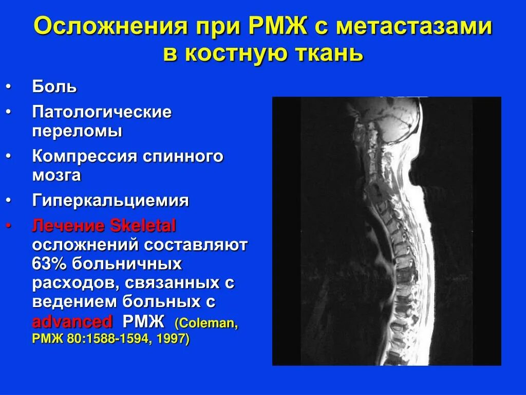 Метастазы в кости срок жизни. Осложнения перелома позвоночника. Метастазы в кости при РМЖ. Перелом позвоночника при метастазах.