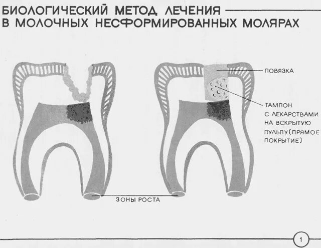 Конкрементозный пульпит. Конкрементозный пульпит. Хронический апикальный периодонтит. Лечение пульпита екатеринбург. Острый серозный пульпит.