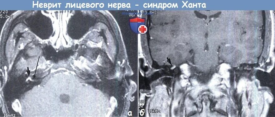 Вазоневральный конфликт тройничного нерва. Неврит лицевого нерва на кт. Нейроваскулярный конфликт лицевого нерва. Мрт лицевых нервов. Мрт лицевого нерва