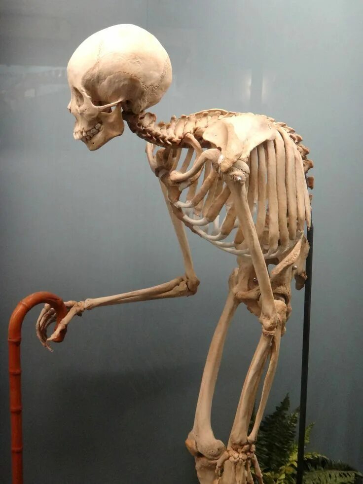 И молодые люди кости человека. Скелет человека. Человеческие кости. Скелет горбатого человека. Человечий скелет.