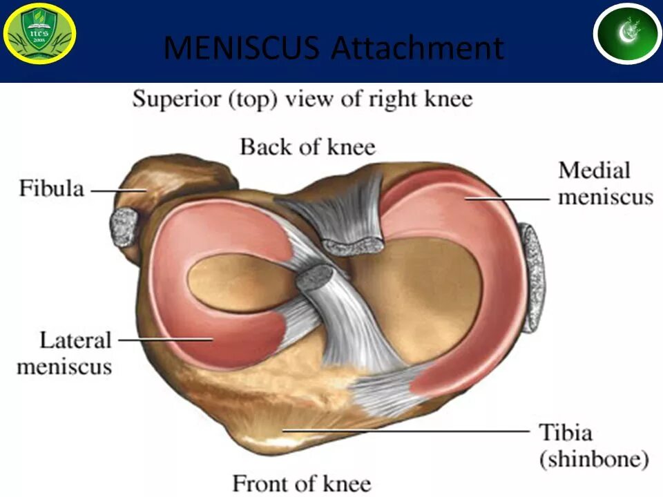 Медиальный мениск коленного сустава анатомия. Менископатия медиального мениска. Внутренний медиальный мениск. Анатомия латерального мениска коленного сустава. Повреждения мениска коленного сустава как лечить