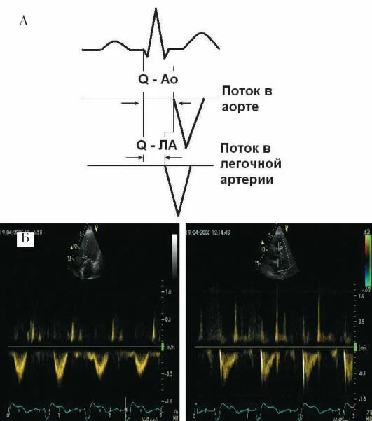 Среднее давление в легочной артерии по ЭХОКГ. Скорость потока в легочной артерии норма. Оценка давления в легочной артерии. Среднее давление в легочной артерии.