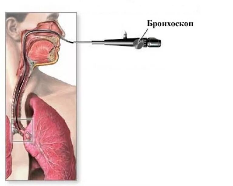 Туберкулез бронхов бронхоскопия. Интубационный бронхоскоп. Бронхоскопия инородное тело. В легкие через нос