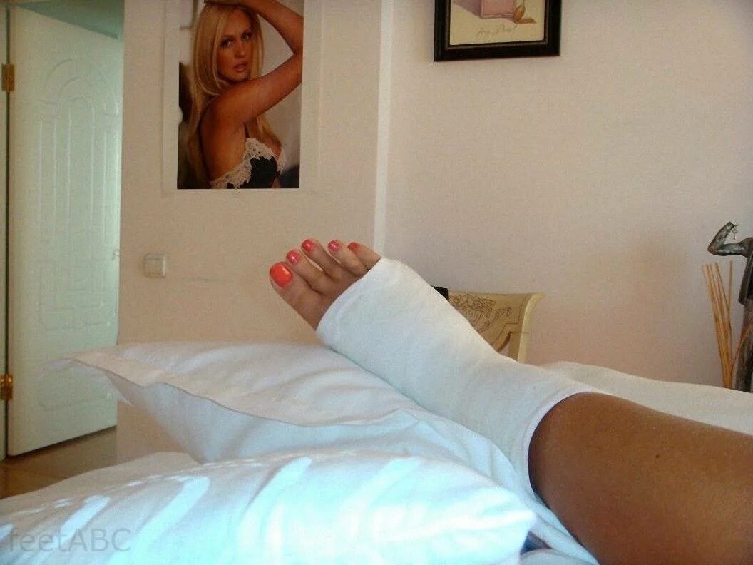 подруга сломала ногу