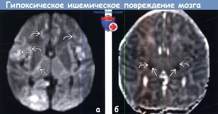 Гипоксическое поражение головного мозга кт. Гипоксия мозга мрт. Ишемическое поражение головного мозга на мрт. Гипоксически-ишемическое поражение мрт. Гипоксические изменения головного мозга