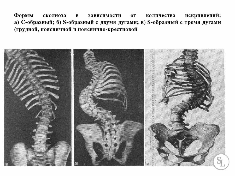 Операция на грудном отделе позвоночника. S образный сколиоз грудного отдела 2-3 степени. S образная сколиотическая деформация грудного отдела позвоночника. S образный сколиоз грудо поясничного отдела 2 степени. Искривление грудного позвоночного отдела 2 степени.