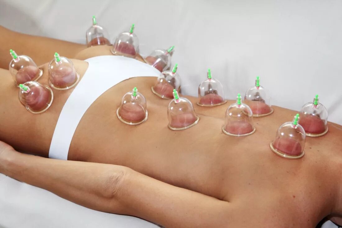 Вакуумная терапия Вельховер. Вакуум терапия баночный массаж. Hijama Therapy аппарат. На сколько ставят банки на спину взрослым