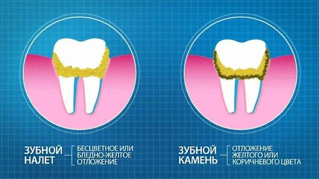 Зубной какамекакамень.