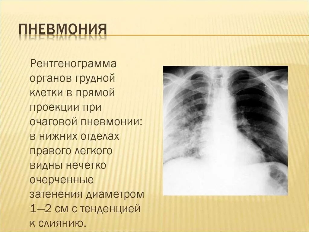 Какое легкое больше и почему. Описание лёгких на рентген пневмонию. Крупозная пневмония рентгенограмма. Очаговая пневмония описание рентгенограммы. Описание рентгена грудной клетки пневмония.