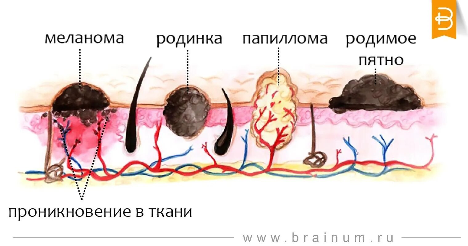 Распад кожи. Папиллома доброкачественная опухоль. Папилломатозный эпидермальный невус. IGE-меланома (злокачественное новообразование кожи).. Воспалилась родинка меланома.