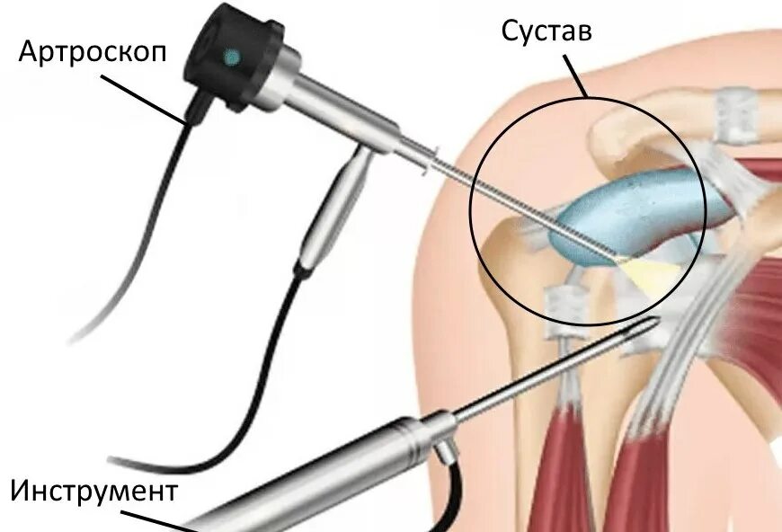 Операция артроскопия коленного. Диагностическая артроскопия плечевого сустава. Операция артроскопия коленного сустава. Артроскопическая субакромиальная декомпрессия плечевого сустава. Операция по замене плечевого сустава