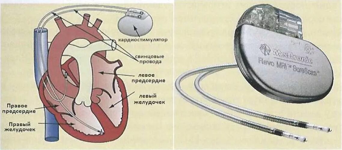 Если стоит кардиостимулятор можно. Однокамерные и двухкамерные кардиостимуляторы. Кардиостимулятор аппарат. Сердечный кардиостимулятор. Установленный кардиостимулятор.