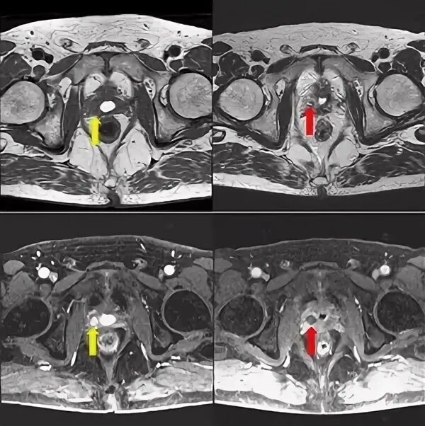 Аденома простаты мрт. Мрт гематома предстательной железы. Карцинома мрт предстательной железы. Мультипараметрическое мрт предстательной железы. Маточка предстательной железы мрт.