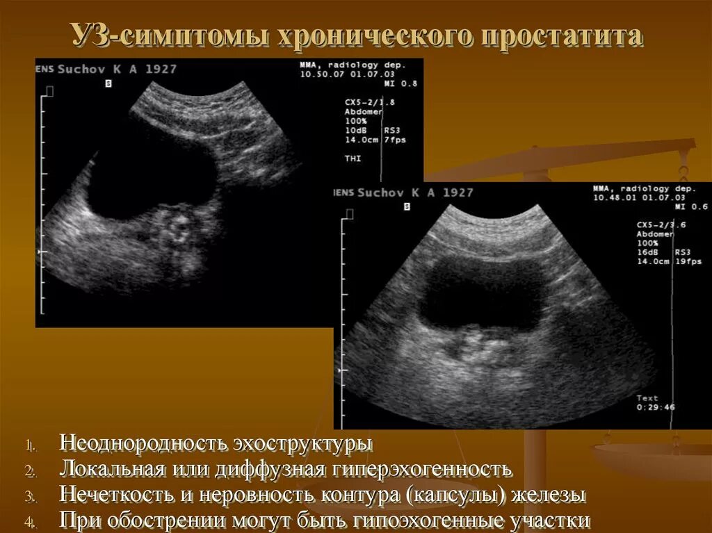 УЗИ признаки хронического простатита. Хронический простатит на УЗИ. Хронический простатит на трузи.