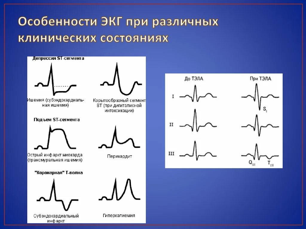 Изменение зубца q. Отрицательный зубец р после QRS комплекса. Патология QRS на ЭКГ. Патологический комплекс QRS на ЭКГ. Патология комплекса QRS на ЭКГ.