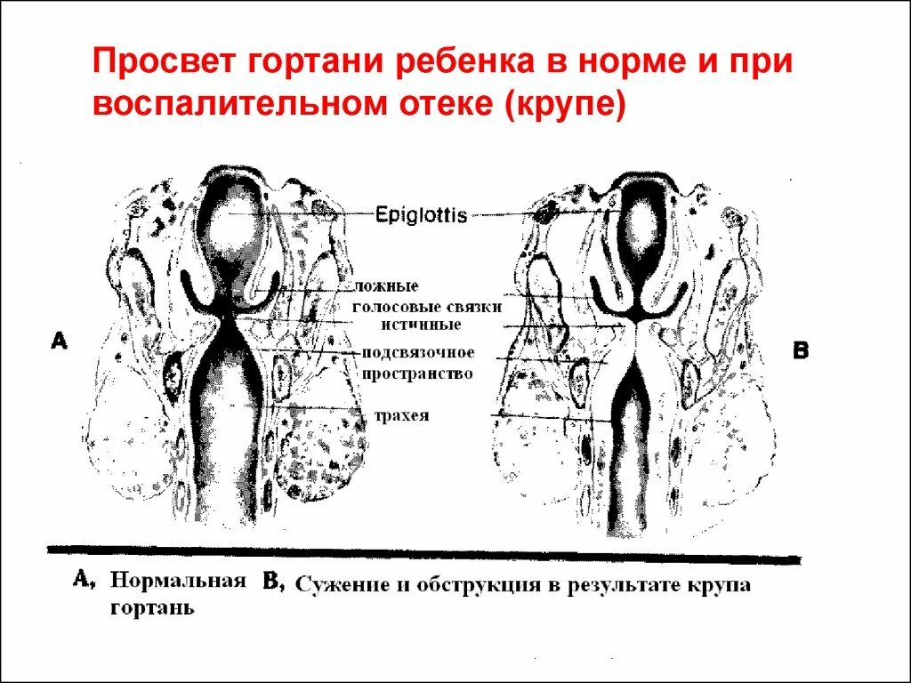 Детская гортань. Анатомо-физиологические особенности гортани у детей. Афо органов дыхания у детей гортань.