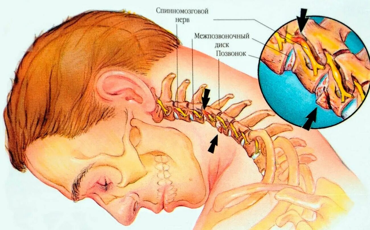 Горловое лечение. Шейный остеохондроз. Защемление нерва в шейном. Остеохондроз шейного отдела.