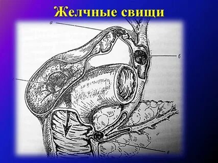 Желчные свищи