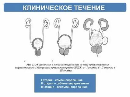 Предстательная железа что такое дгпж