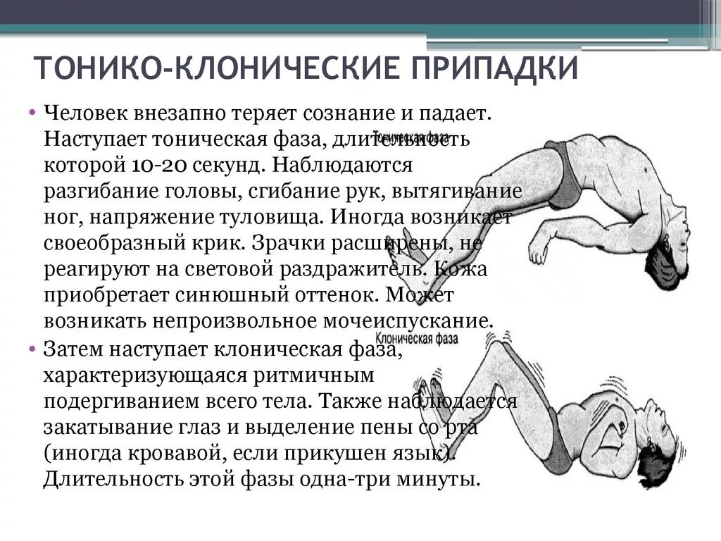 Приступ судорожной эпилепсии. Генерализованные тонико-клонические судороги - признак. Симптомы тонико-клонической эпилепсии. Эпилептический припадок клинические симптомы. Клонические судороги при эпилепсии.