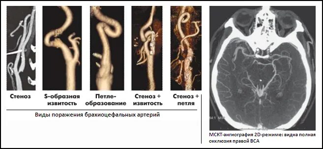 Изгиб вса. Кт ангиография брахиоцефальных сосудов. Кт ангиография сосудов головного мозга. МСКТ ангиография брахиоцефальных артерий бца. Брахиоцефальный ствол анатомия кт.