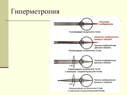 Гиперметропия слабой степени код