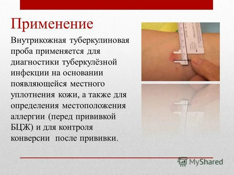 Туберкулинодиагностика реакция манту. Туберкулиновая проба диаскинтест это. Туберкулинодиагностика (проба манту с 2 те). Туберкулин внутрикожно. Что такое прививка дст детям в школе