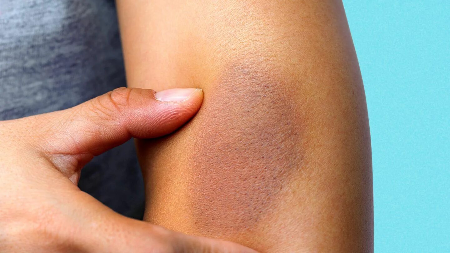 Камертоны на коже. Втирание мази. Нажимаю на кожу. Потертость кожи человека. Дерматит на локтевых сгибах.