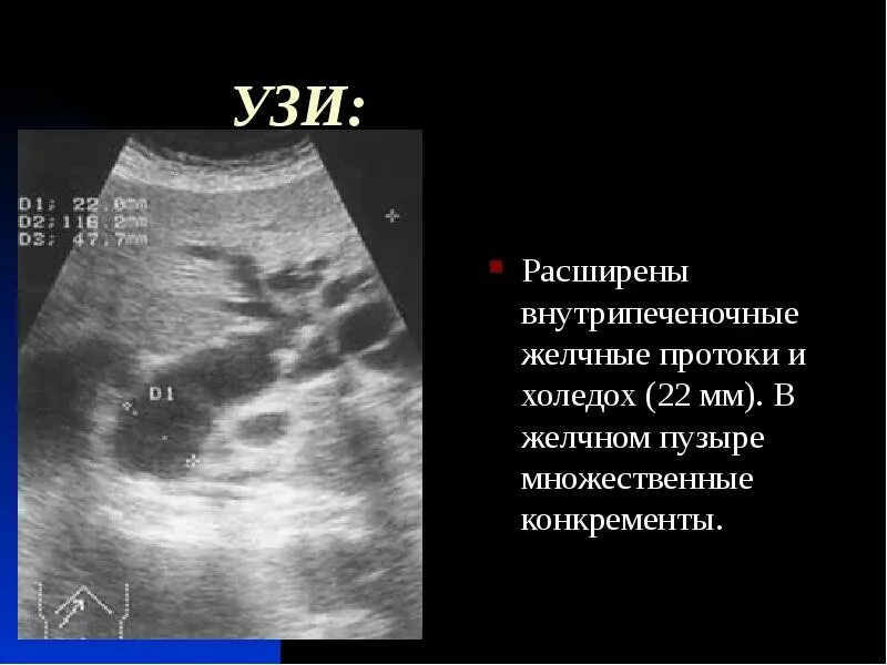 Расширение внутрипеченочных протоков на узи. Проток желчного пузыря холедох. Холедох и желчный пузырь на узи. Расширение внутрипеченочных желчных протоков узи. Расширенный проток желчного пузыря.