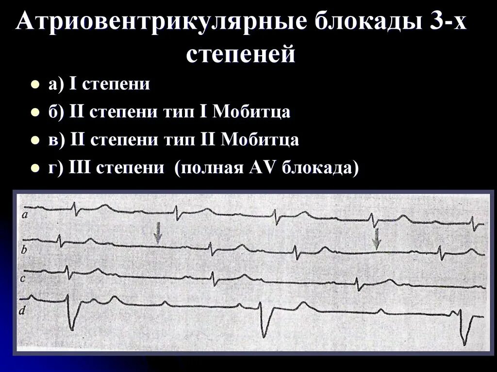 Полная атриовентрикулярная блокада. Атриовентрикулярная блокада i-III степени. АВ блокада 3 степени. Атоветрикулярная блока з сткпени. Полная АВ блокада 3 степени.