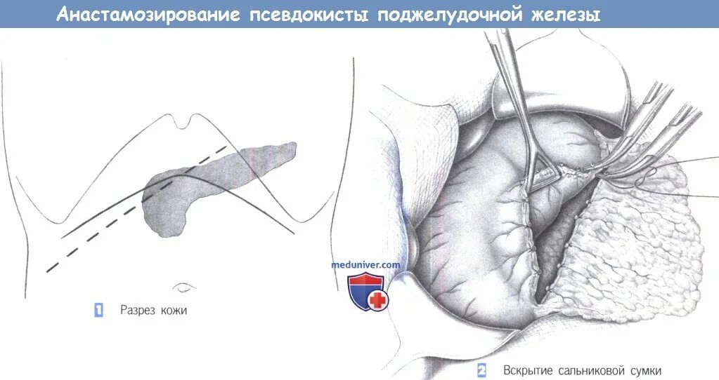 Корпорокаудальная резекция поджелудочной железы этапы. Дистальная корпорокаудальная резекция поджелудочной железы. Сальниковая сумка поджелудочной железы. Дренирование поджелудочной железы.