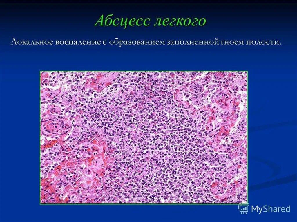 Гнойные абсцессы легких. Острый абсцесс легкого микропрепарат. Стафилококковая абсцедирующая пневмония микропрепарат. Микропрепарат Метастатические абсцессы в легких. Абсцесс печени патанатомия.