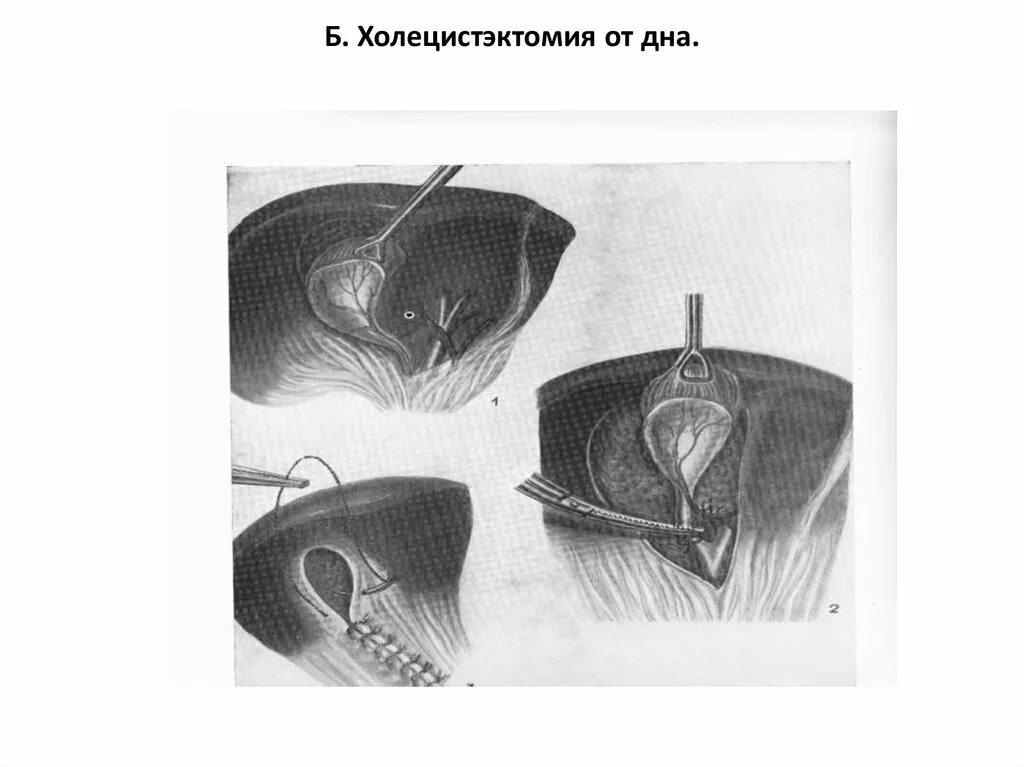 Этапы холецистэктомии. Ретроградная холецистэктомия. Этапы операции холецистэктомии ( от шейки). Антеградная и ретроградная холецистэктомия. Холецистэктомия Оперативная хирургия.