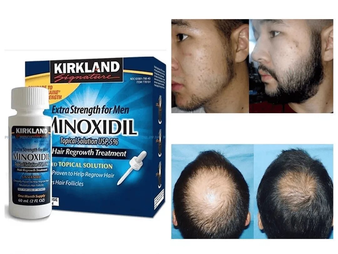 Миноксидил побочные. Миноксидил Киркланд Minoxidil Kirkland 5%. Original Minoxidil 2022. Миноксидил Киркланд 5 для бороды. Миноксидил 5 narxi.