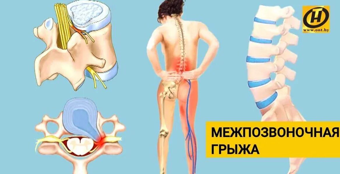 Холодноплазменная нуклеопластика межпозвонковых дисков. Лечение грыжи безоперационно. Межпозвоночная грыжа. Междисковая грыжа позвоночника. Безоперационное лечение межпозвоночной.