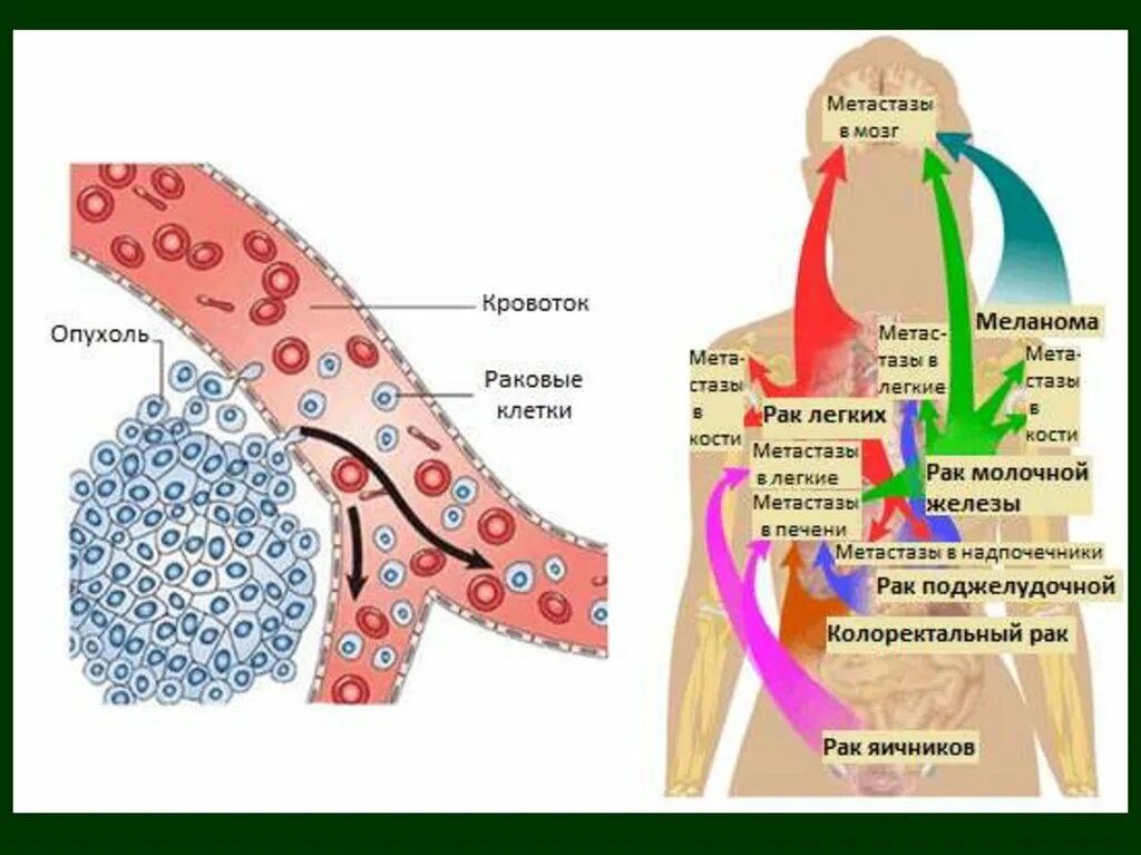 Печень и молочные железы. Гематогенный путь метастазирования опухоли. Схема метастазирования опухолевых клеток. Пути метастазирования опухолей схема. Схема распространения метастазов.