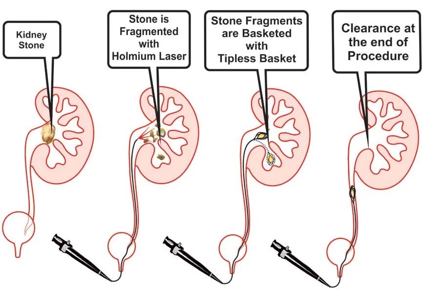 Стенд в мочеточнике стент в мочеточнике. Стент внутреннего дренирования почки. Операция стент мочеточника. Стенд в мочеточнике при камнях. Снятии стента