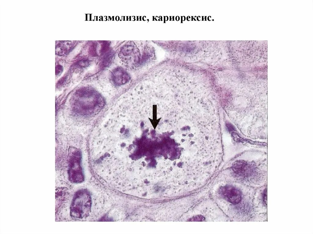 Кариопикноз это. Кариопикноз кариорексис. Кариорексис это гистология. Кариопикноз кариорексис кариолизис апоптоз. Кариорексис некроз.