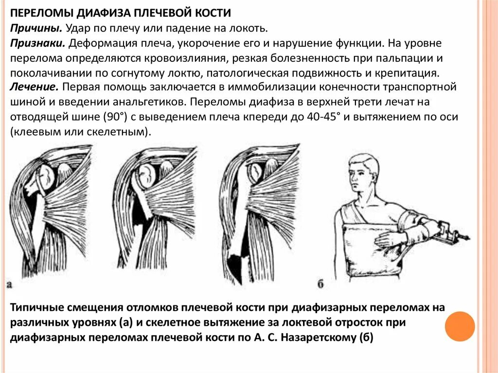 Переломы диафизп Плеа классфиуация. Переломы диафиза плечевой кости классификация. Классификация переломов диафиза плеча. Перелом средней трети диафиза плечевой кости. Повреждения правого плечевого сустава