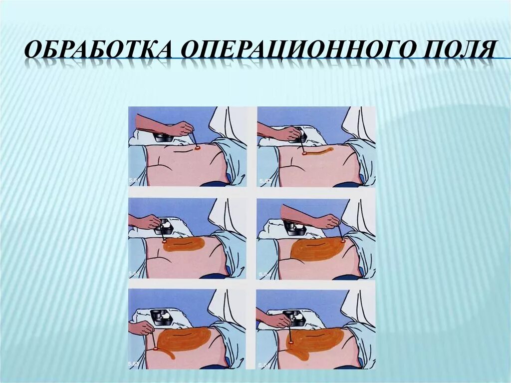 Подготовка поля операции. Обработка операционного поля. Обработка операционного поля по Гроссиху-Филончикову. Принципы обработки операционного поля. Обработка операционного поля презентация.