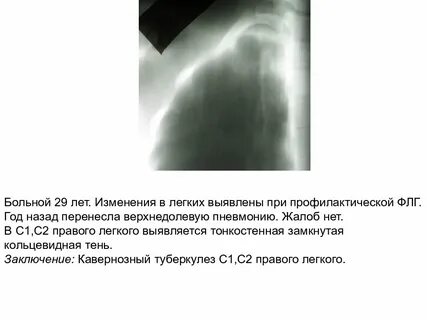 Синдромы при туберкулезе легких