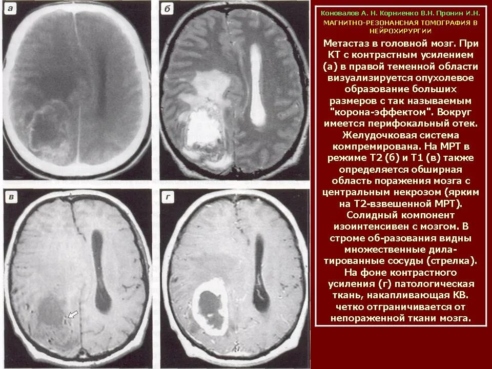 Метастазы в мозг прогноз. Метастазы головного мозга кт.