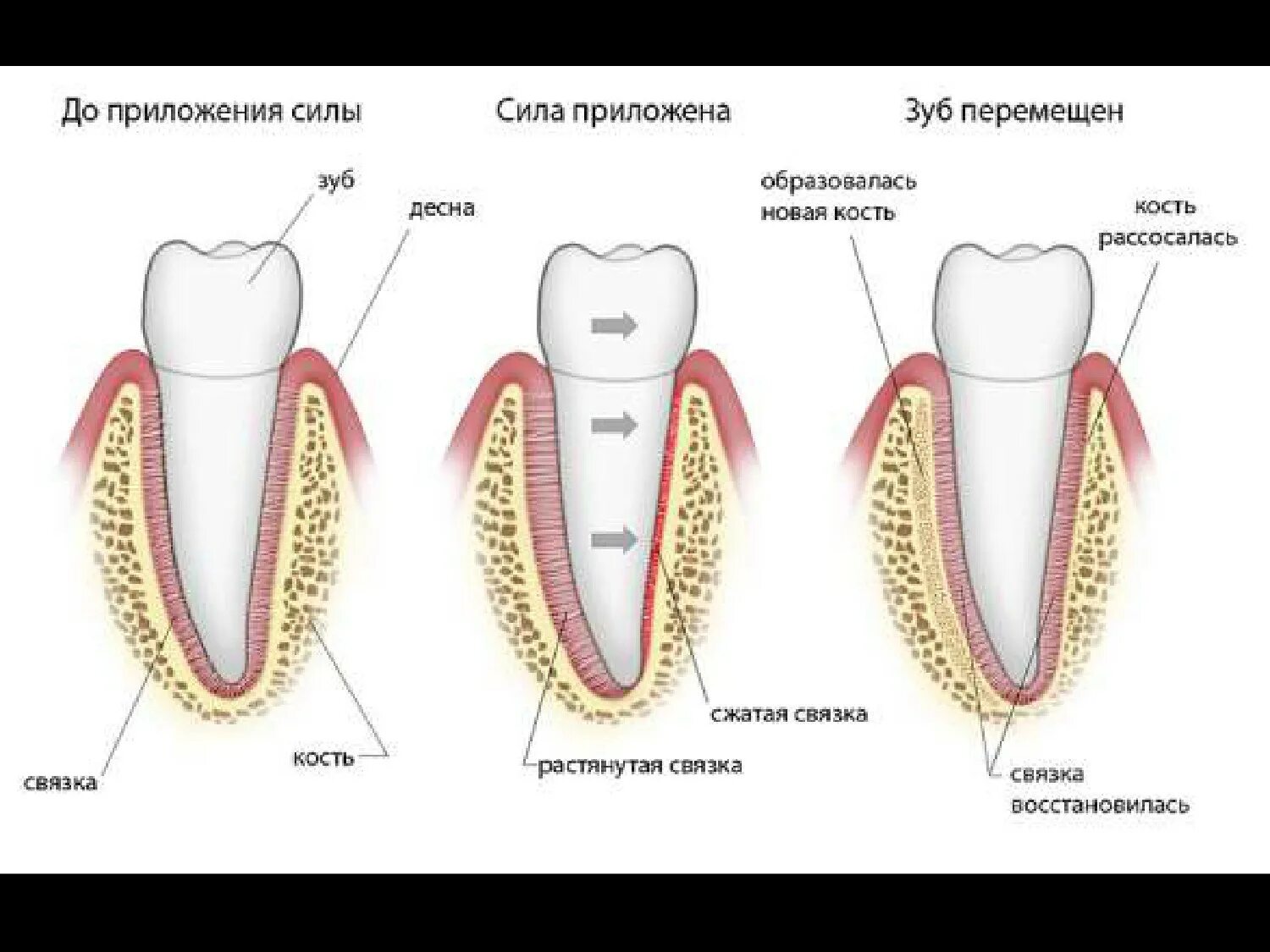 Брекеты схема установки. Зуб.