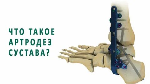 Артродез это