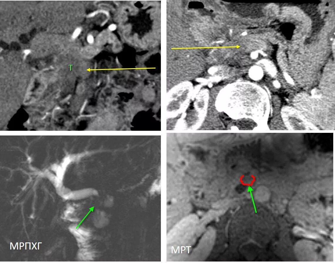 Внутреннее строение поджелудочной железы. Поджелудочную удаляют полностью. Поджелудочную удаляют полностью. Резекция поджелудочной. Поджелудочную удаляют полностью.