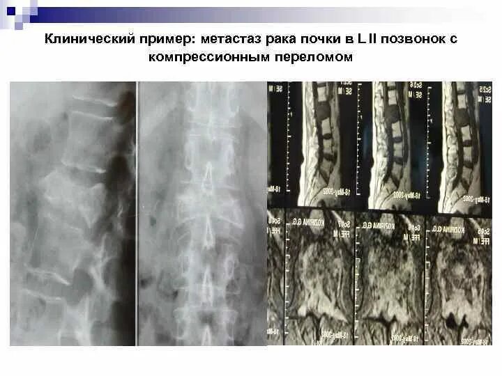 Метастазы в кости при раке предстательной