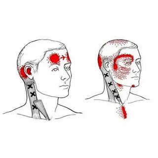 Грудино ключично сосцевидная мышца боль
