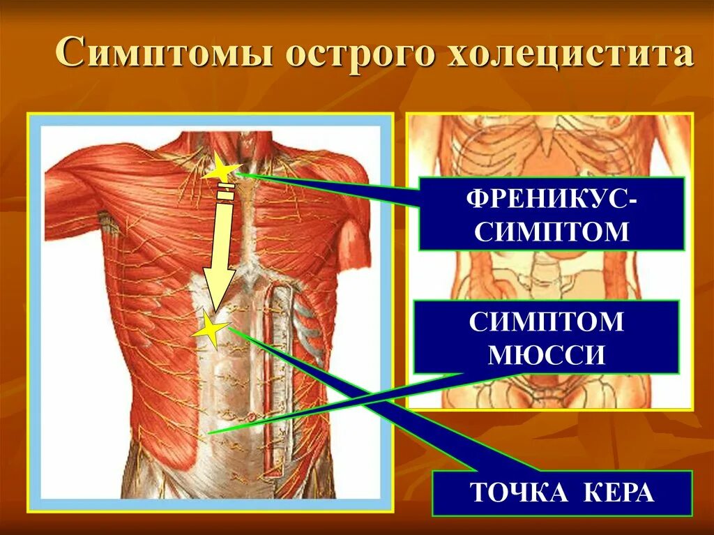 Боль в правом подреберье лечение холецистита. Острый холецистит симптомы. Симптомы при остром холецистите. Симптомы острогог холестетит. Признаки холецистита.