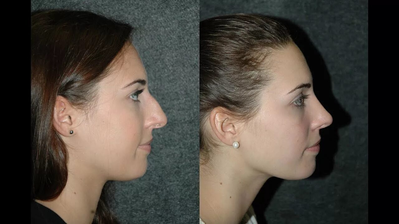 Фото ринопластики до и после нос. Ринопластика Эленшлегер. Пластика носа. Ринопластика кончика носа. Нитевая коррекция носа.