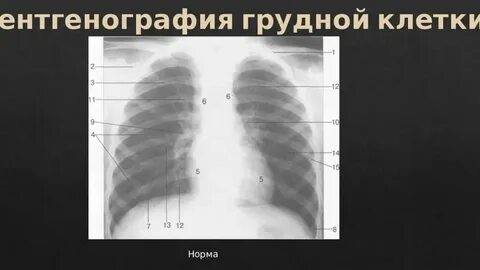 Рентген грудной клетки у детей